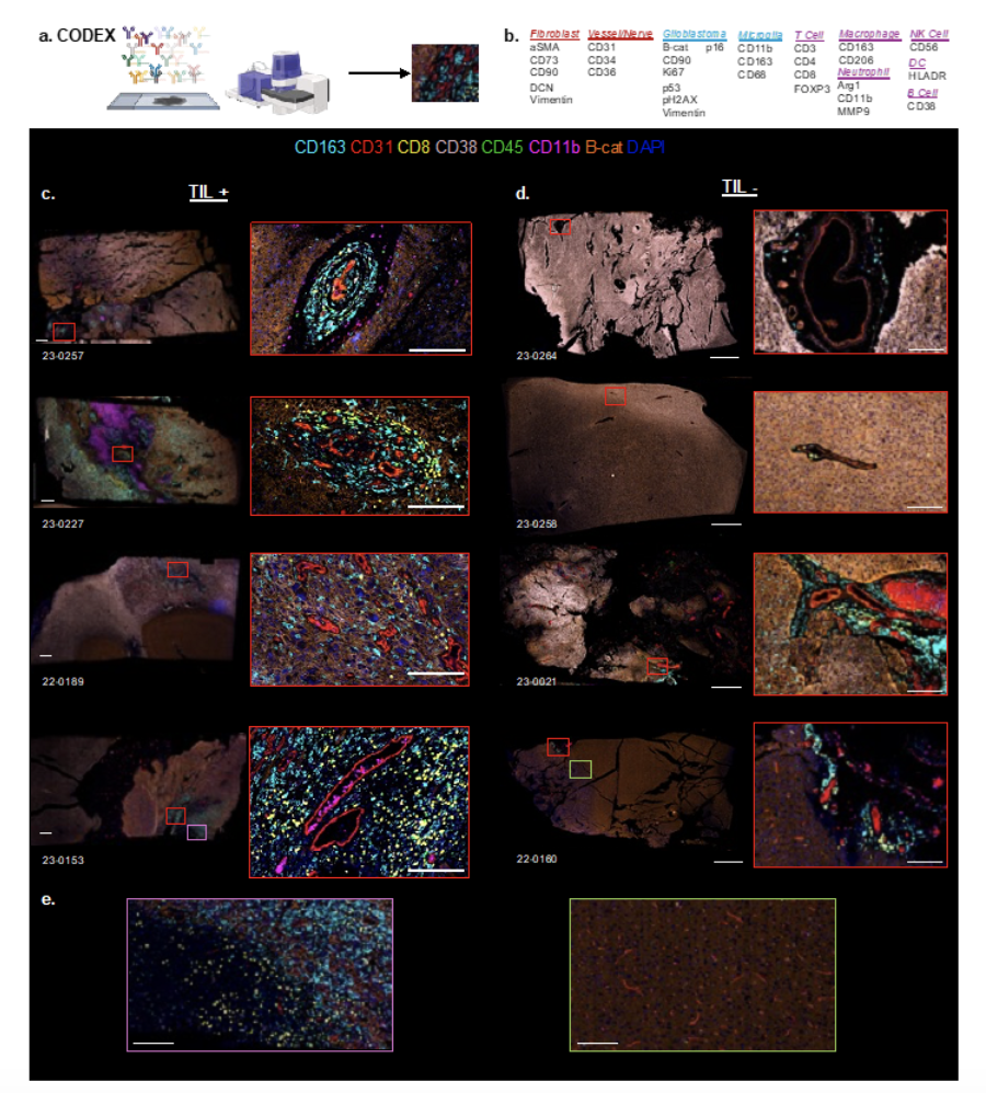 A Spatial Multi-Omic Framework Identifies Gliomas Permissive to TIL Expansion (PREPRINT)